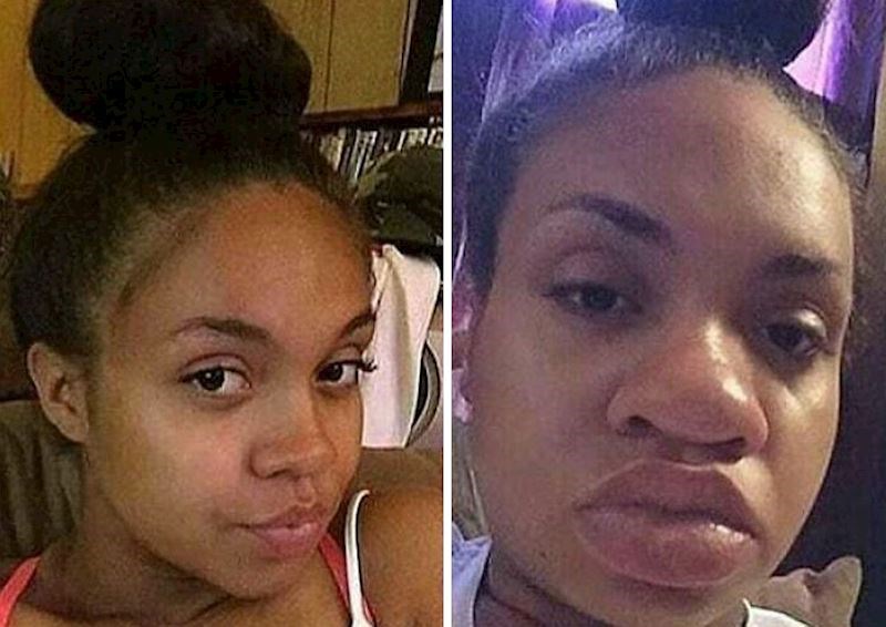 Neki dijelovi tijela naglo će se početi povećavati, jako često u pitanju je nos