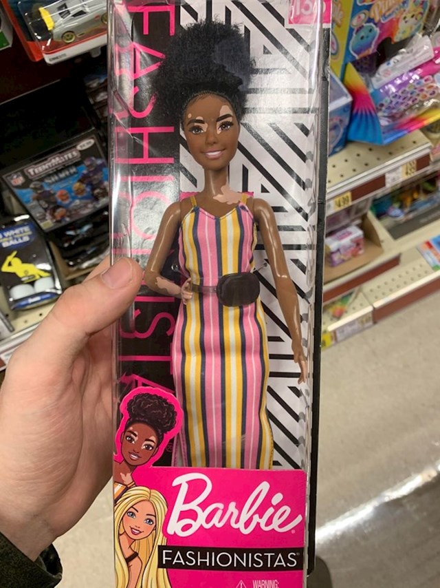 Barbie s vitiligom