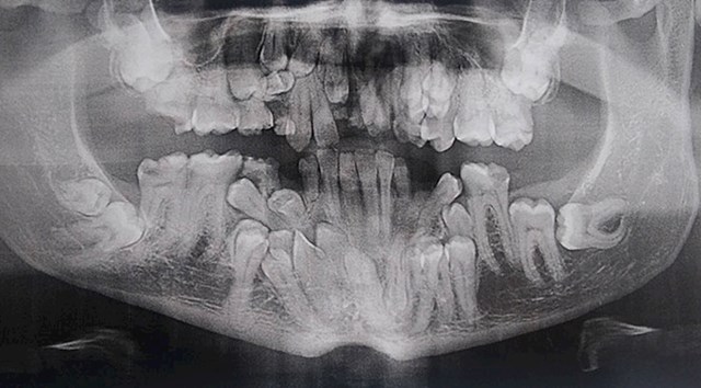 Rijetki poremećaj kleidokranijalna displazija; ovaj čovjek ima prekobrojne zube