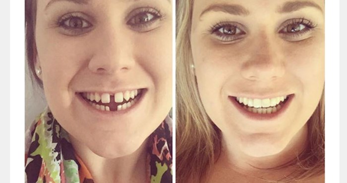30 fotki nevjerojatnih transformacija nakon aparatića za zube