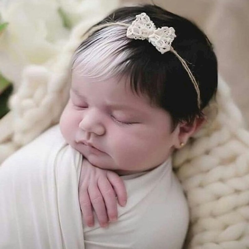 Genska mutacija koju ima zove se piebaldizam