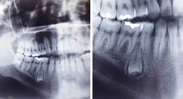 Otišla sam u zubara i saznala da imam zub koji raste naopako