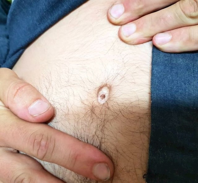 Imam madež u pupku