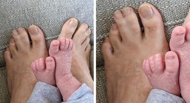 Ima spojene prste na nogama, a sin je naslijedio istu posebnost!