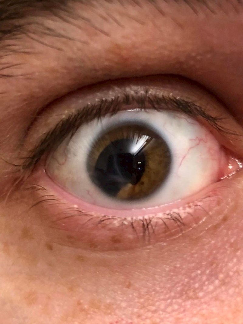 Ovako izgleda moje oko nakon nesreće koju sam doživio kad sam imao 16 god.