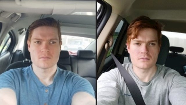 Prije i nakon operacije čeljusti