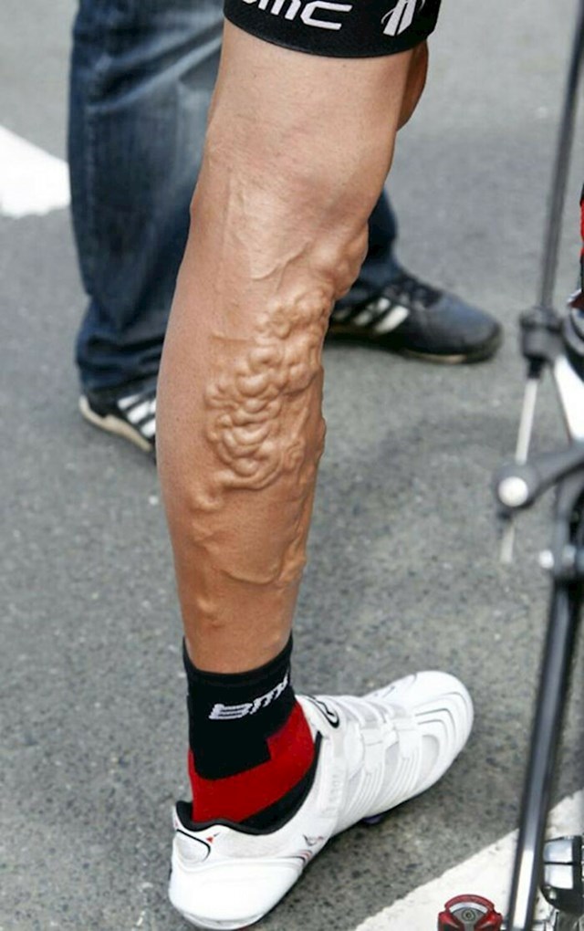 Noge biciklista nakon utrke