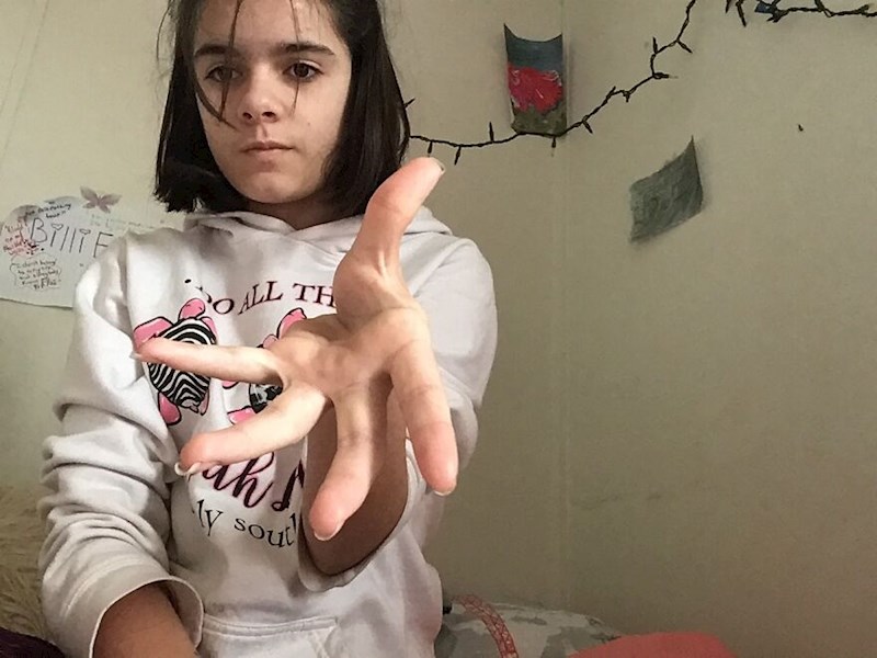 14. Ova cura može dislocirati palac po želji