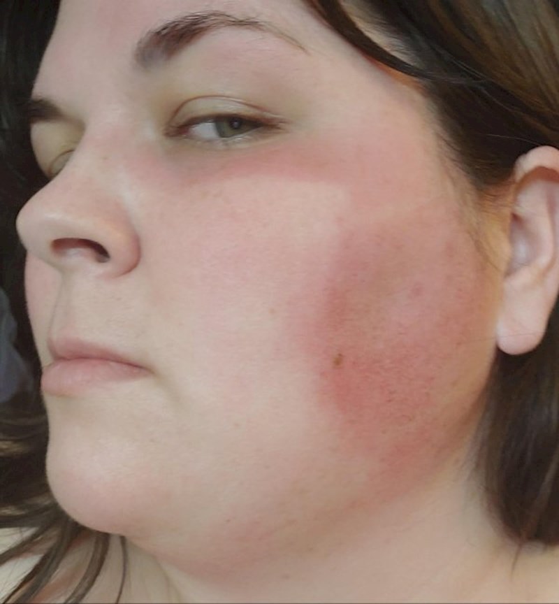 Ja sam sestra koja radim na cijepljenju ljudi na vanjskim punktovima i nisam shvatila da je došlo vrijeme za SPF i sad mi pola lica ima otisak maske