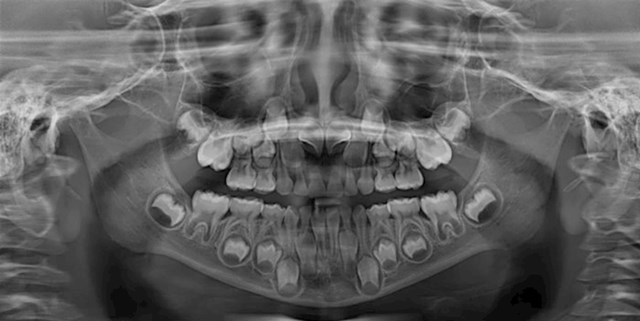 Snimka dječjih usta, vide se mliječni zubi i trajni koji su spremni za rast