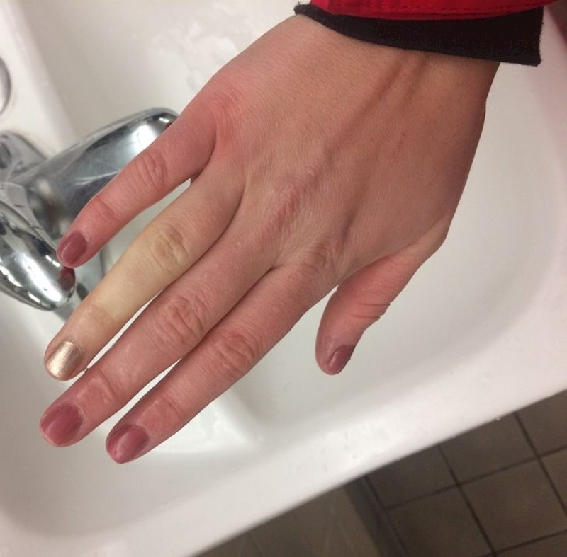 Kad je hladno, svi prsti pocrvene osim jednog