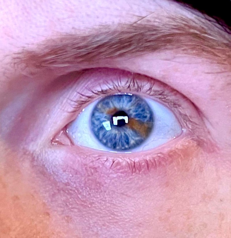 Moje lijevo oko je u dvije boje