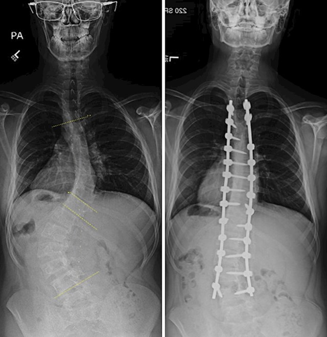 Prije i poslije operacije skolioze