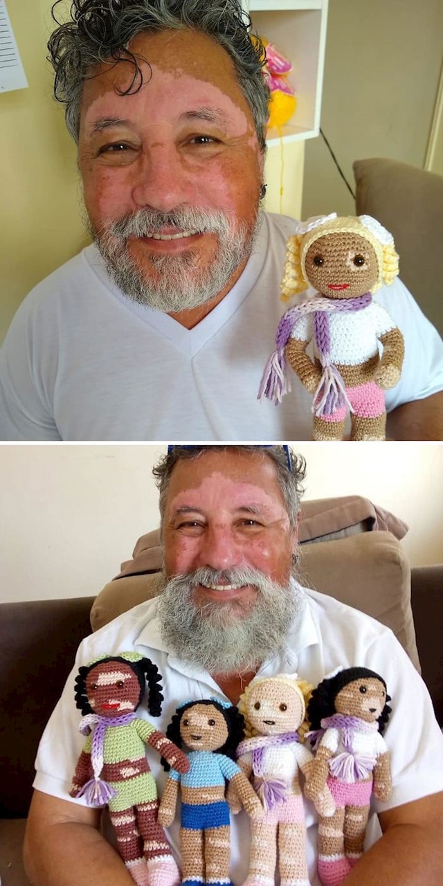 Moj djed ima vitiligo i izrađuje igračke s vitiligom kako bi se djeca koja isto boluju od vitiliga osjećala normalno i prihvaćeno