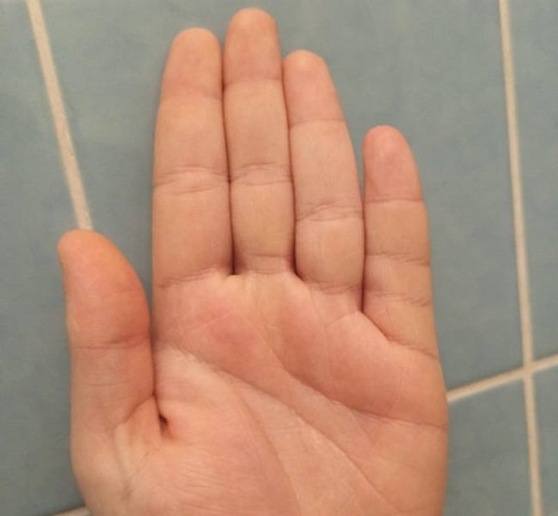 Imam dodatan zglob na malom prstu