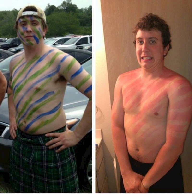 Zaboravio je staviti kremu s faktorom