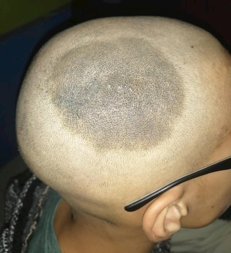 Na vrhu glave imam ogromni crni madež