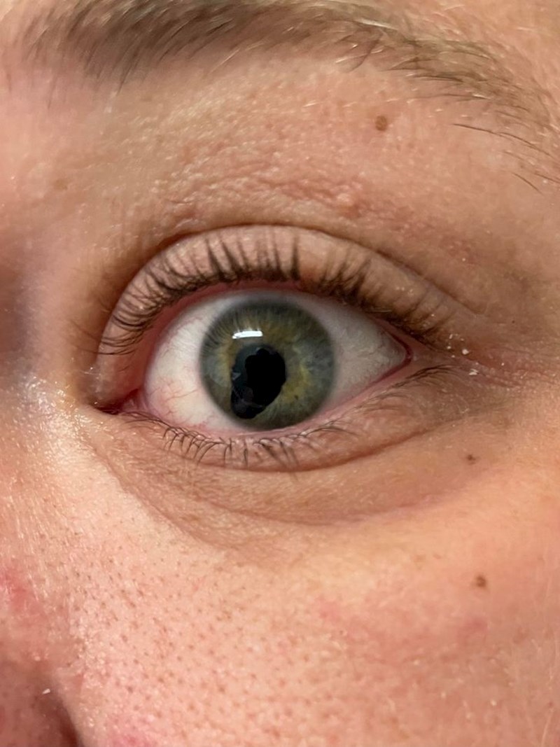 Imala je operaciju zbog koje joj zjenica izgleda ovako