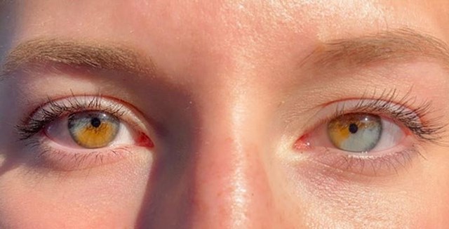 Imam heterokromiju (razliku u boji) na oba oka
