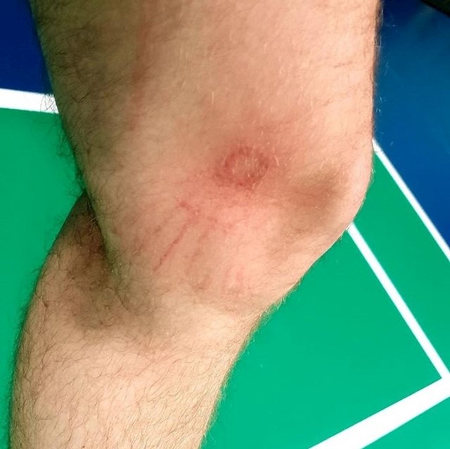 Badminton može biti opasan