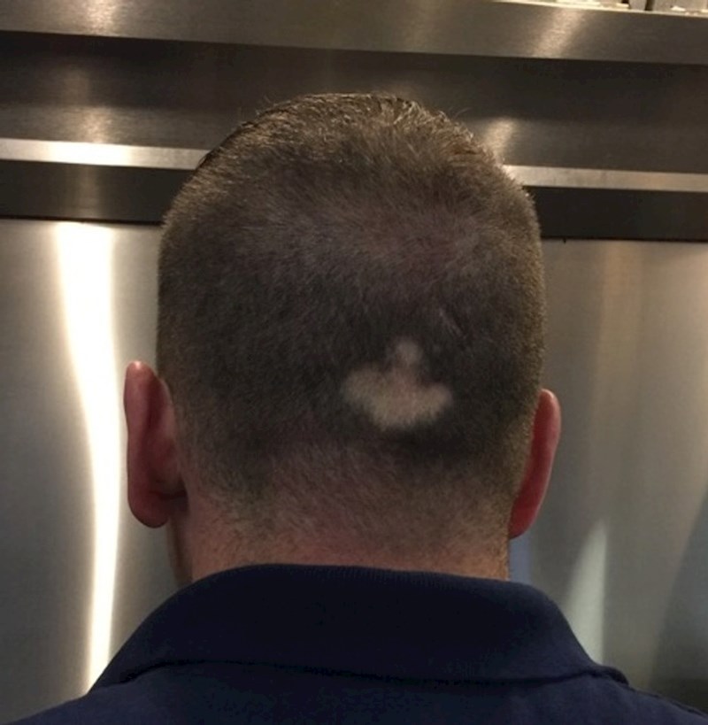 Od rođenja imam ovaj ćelavi dio na glavi. Nikada mi tu nisu rasle dlake.