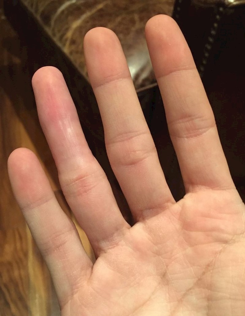 Nosio sam longetu tako dugo da više nemam crtu na prstenjaku