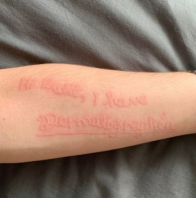 Mogu crtati po svojoj koži, stanje se zove dermatografija