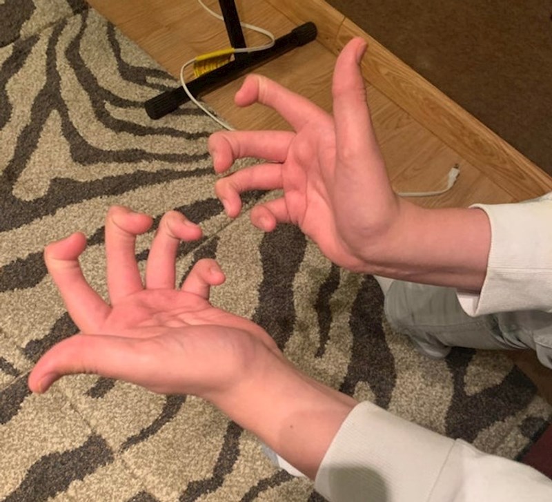 Nema srednje članke na prstima.