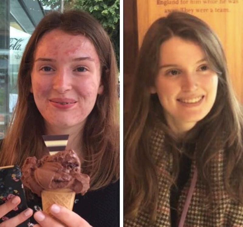 Riješila sam svoj problem s aknama