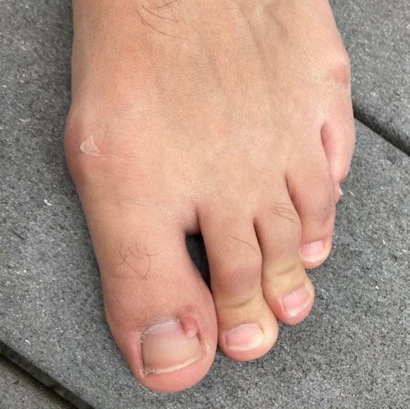 Moj palac na sebi ima mali palac sa svojim posebnim noktom