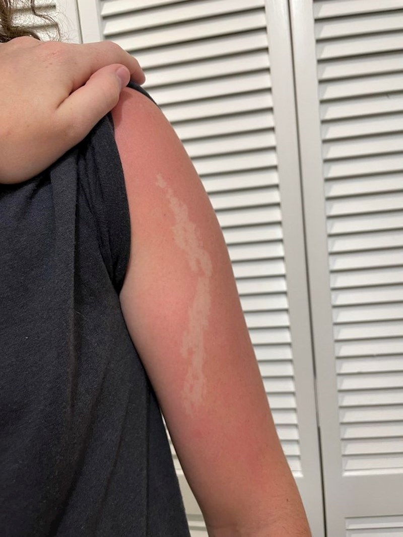 Rođena je s ovim, jedini dio kože koji nikad ne pocrveni na suncu