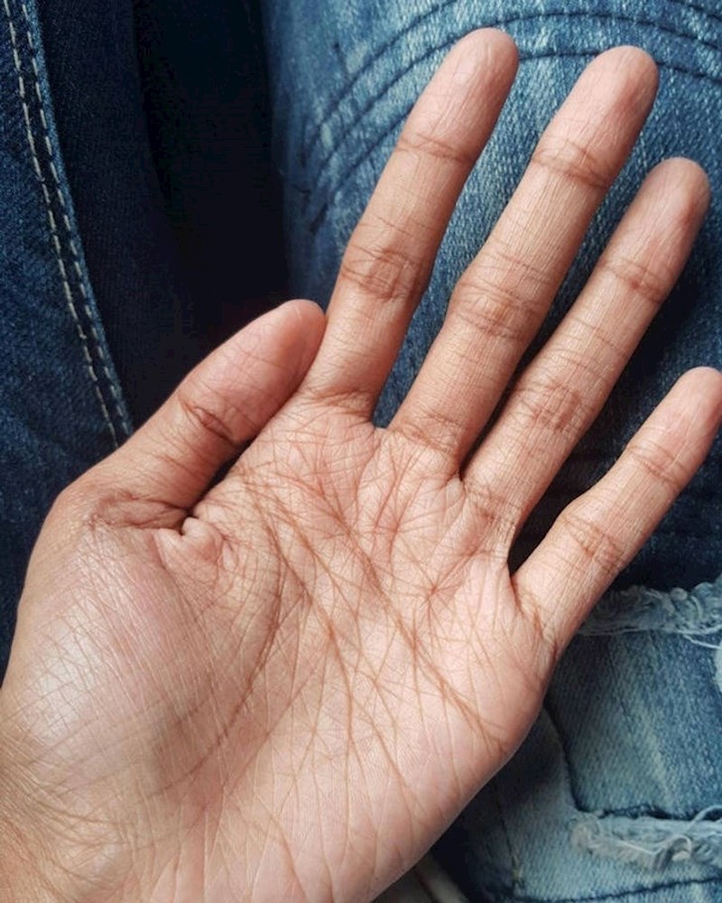 Ruke su mi ekstra naborane