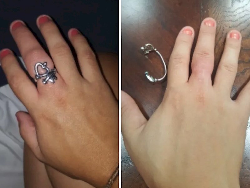 Otečene ruke jedna je od najčešćih "nuspojava" trudnoće