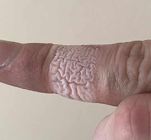 Koža nakon što smo skinuli flaster koji je dugo stajao