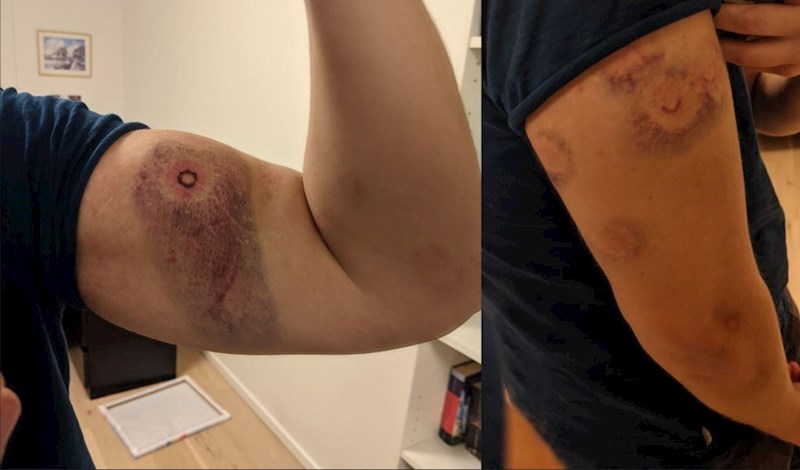 Išao je na paintball bez zaštite