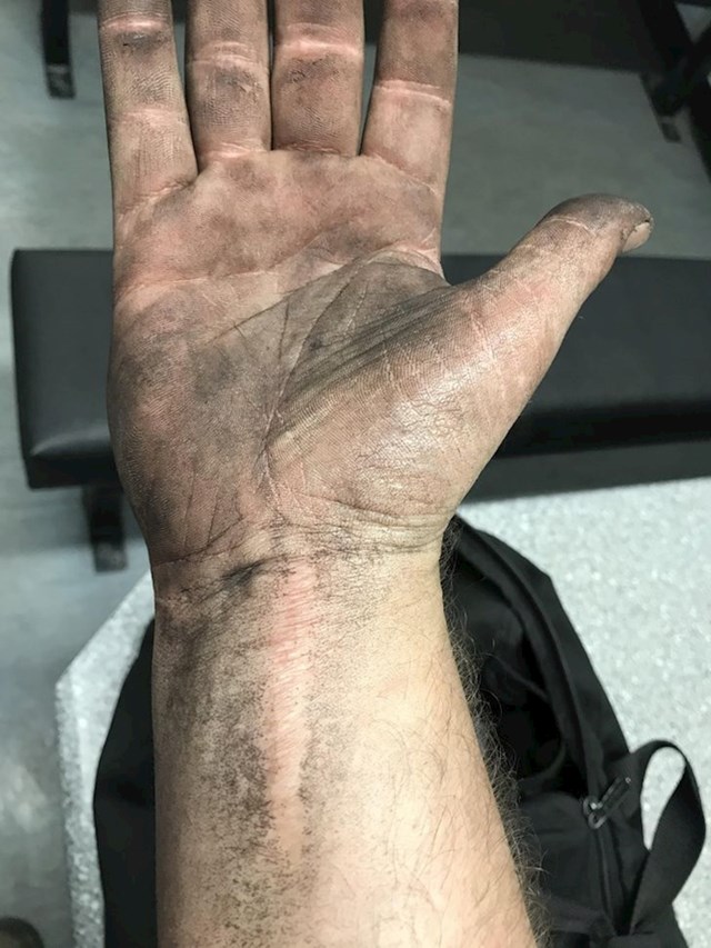 Radim u rudniku, ugljen se nikad ne hvata za ožiljak na mojoj ruci