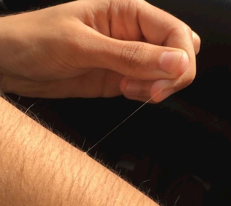 Imam jednu abnormalno dugu dlaku na ruci