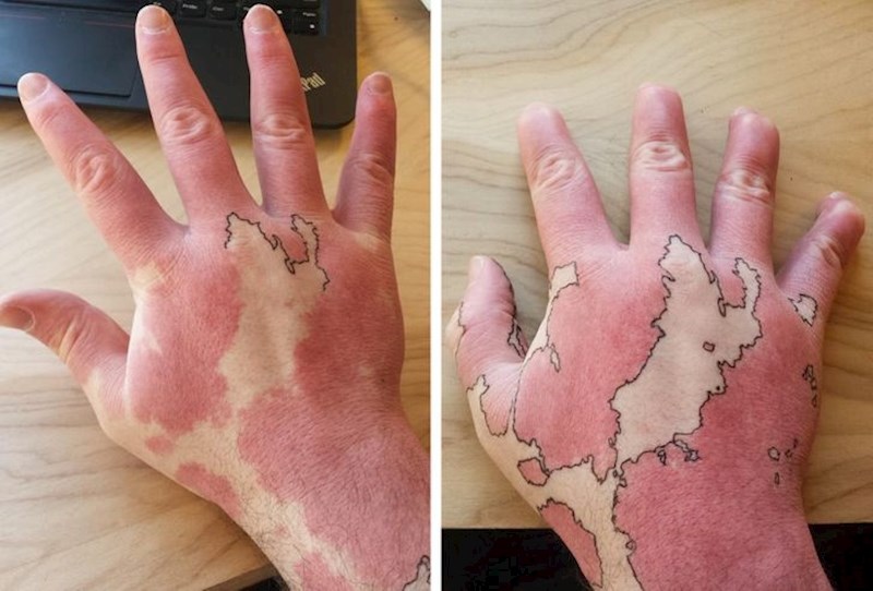 Mala nesavršenost dobivena rođenjem koja izgleda kao mapa