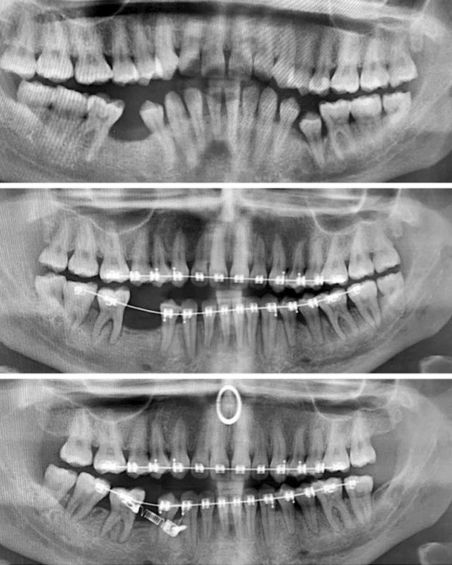 Ispravljanje zubi u razmaku od 2 godine