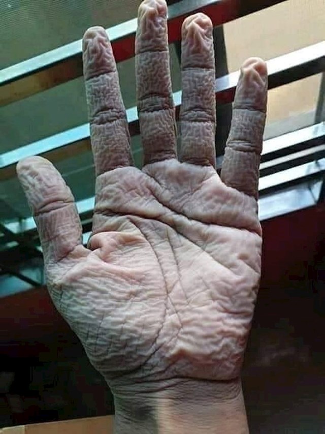 Ovako izgleda kada liječnik skine gumene rukavice nakon smjene od 12 sati