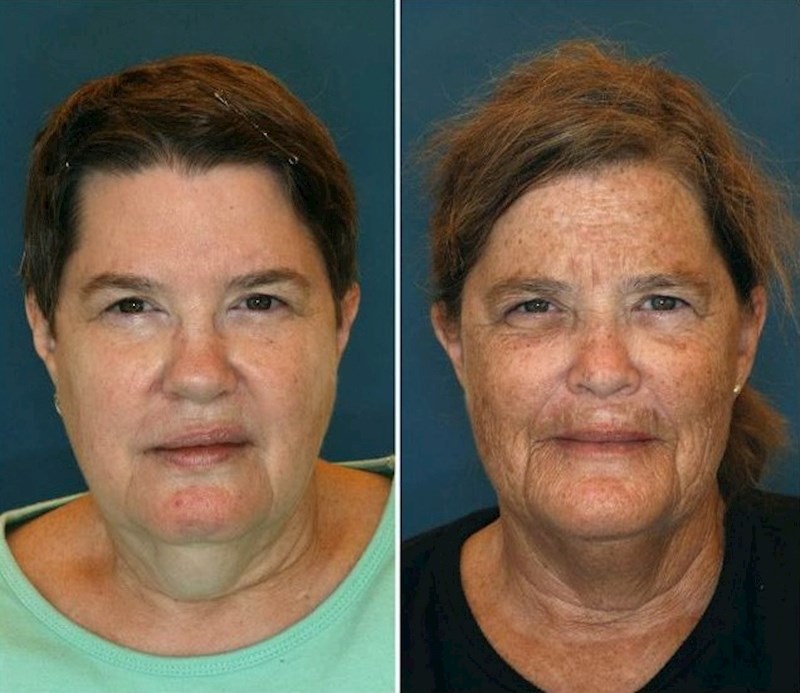 Sestra na desnoj slici puši cigarete 16 godina, dok sestra na lijevoj slici ne puši