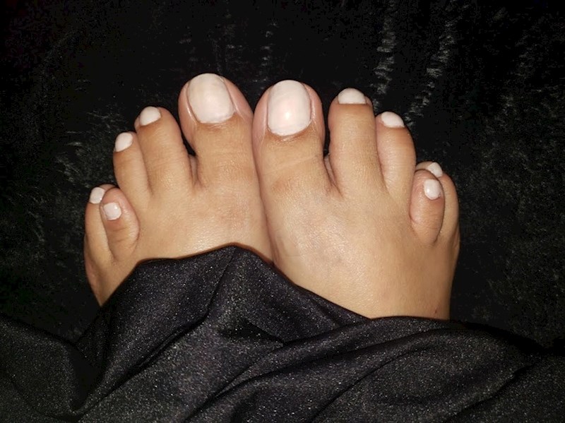 "Imam stanje koje se zove brachymetatarsia i moji prsti izgledaju ovako"