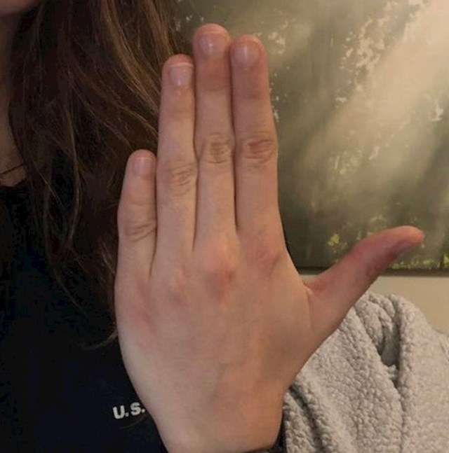 "Mali prst na ruci mi je manji nego drugim ljudima"