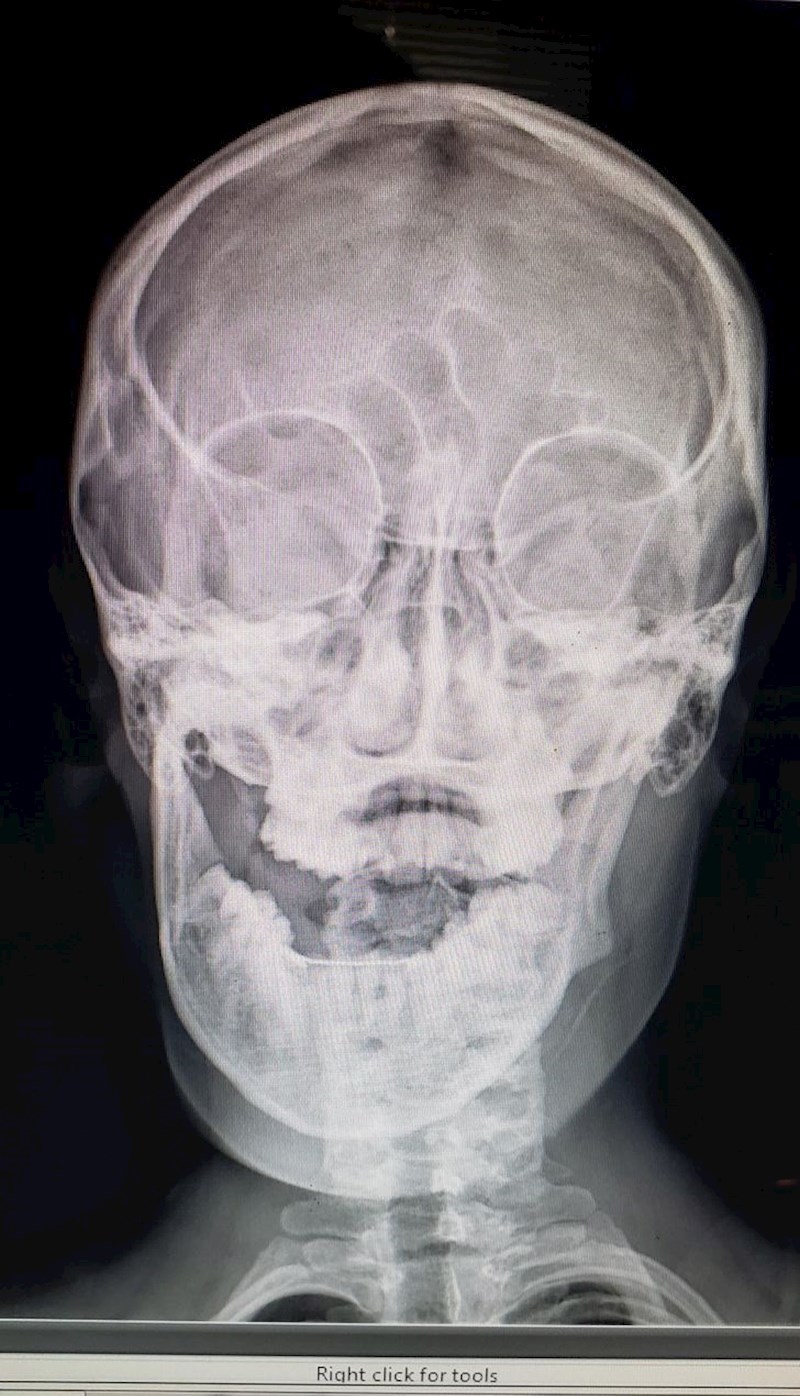 "Dislocirala mi se čeljust dok sam jela pahuljice..."