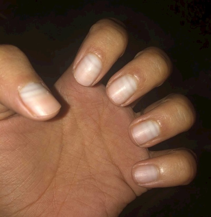 Tragovi kemoterapije na noktima, vodoravne linije označavaju prekid i ponovni rast noktiju