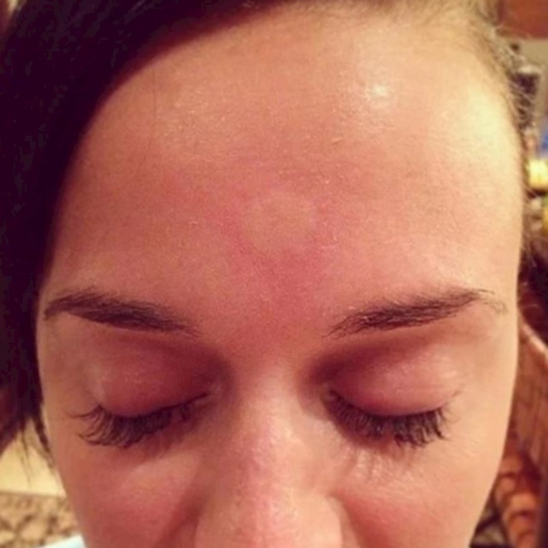 Ugrizao ju je komarac baš na dan vjenčanja...