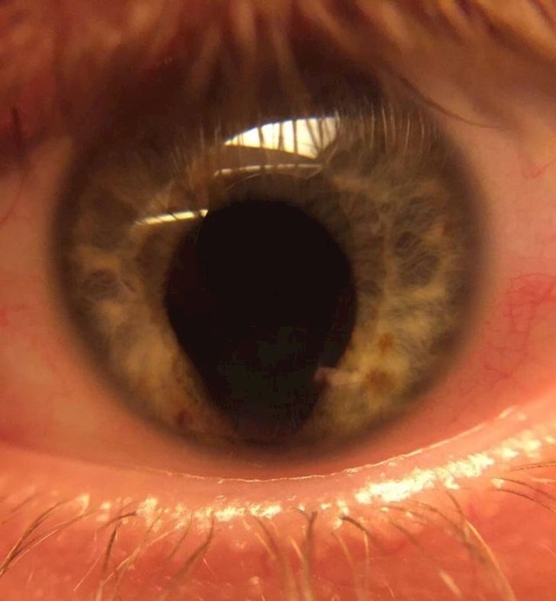 "Rođen sam s proširenom zjenicom"