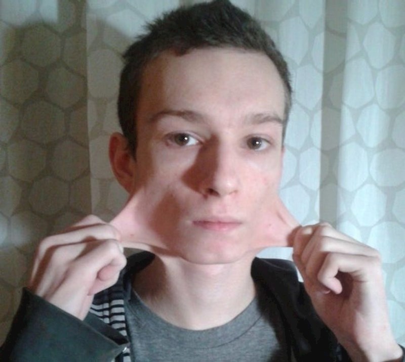 Ovaj mladić rođen je s jako fleksibilnim zglobovima i rastezljivom kožom