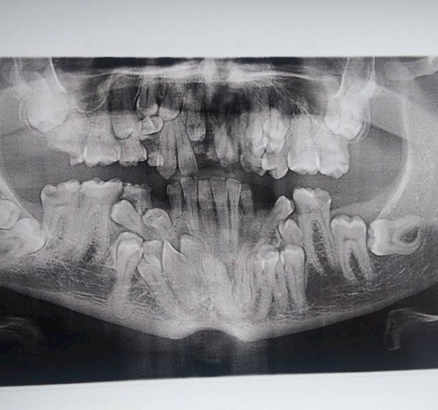 "Imam rijedak poremećaj zvan kleidokranijalna disostoza, to su sve moji zubi"