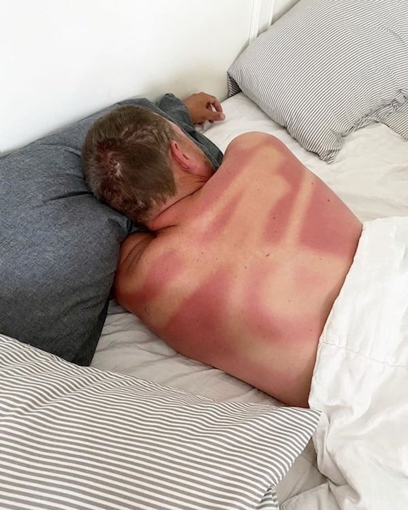 Kad pokušaš sam sebe namazati kremom za sunčanje...